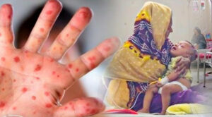 একদিনেই হাম উপসর্গে ১১ জনের মৃত্যু